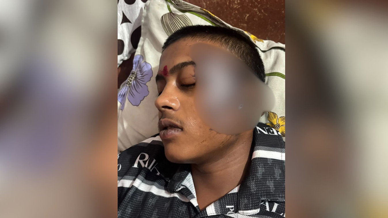 20 रुपये के मोमोज को लेकर विवाद, छात्र पर फेंका खौलता तेल; चेहरा-कान झुलसे, आरोपी फरार